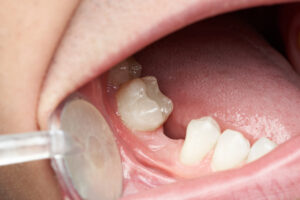 Missing tooth space in mouth close-up. Doctor dentist look into open mouth
