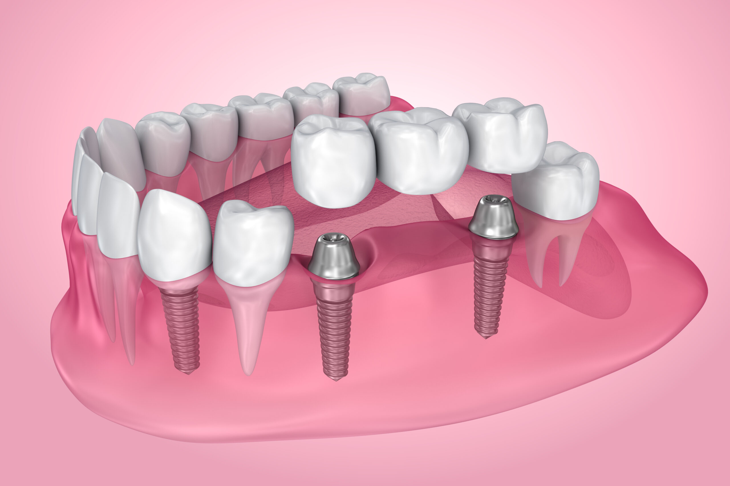 implant supported fixed bridge. Transparent view . Medically accurate 3D illustration