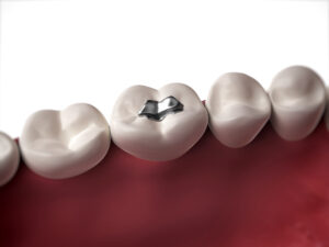 3d rendered illustration of an amalgam filling