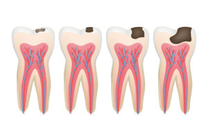 Caries tooth. Decay pulpit dental problem procedure root vector tooth medical pictures. Dental medicine, medical procedure, healthy cavity illustration