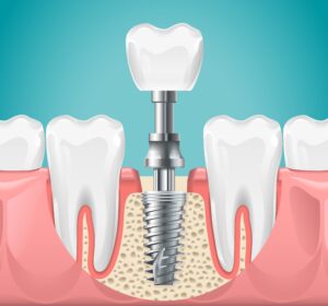 Dental surgery. Tooth implant cut vector illustration. Healthy teeth and dental implant, stomatology poster. Implant dental metal screw in gum