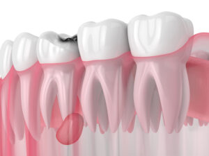3d render of jaw with tooth cavity and cyst. Dental problem concept.