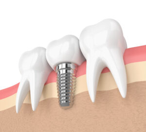 3d render of teeth with dental implant in gums over white background