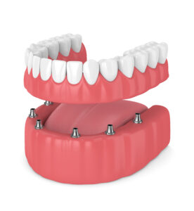 3d render of removable full implant denture isolated over white background