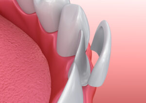 Dental Veneers: Porcelain Veneer installation Procedure. 3D illustration