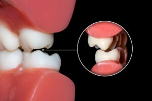 dental occlusion molars teeth close up