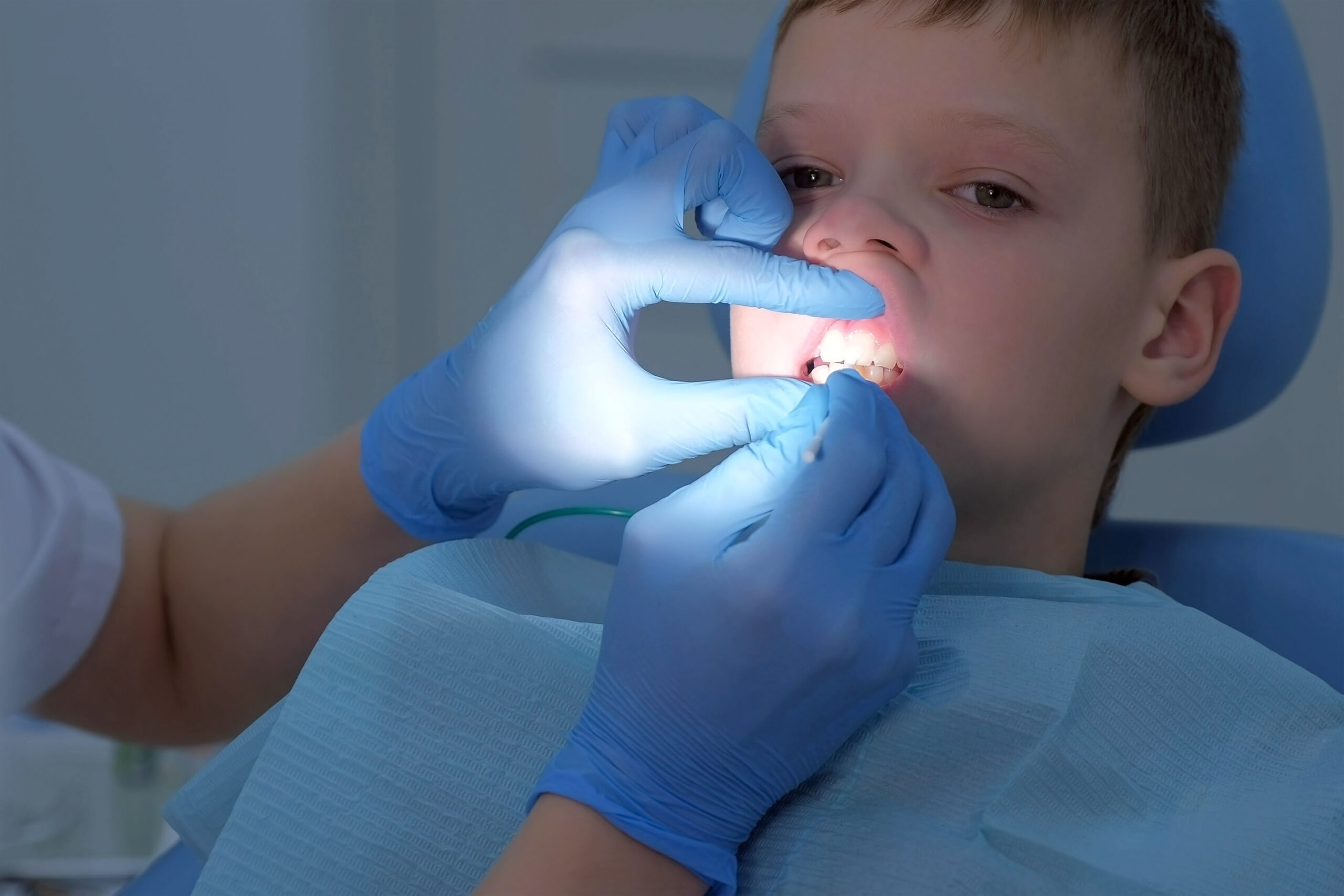 Dentist making fluoridation of child boy teeth after cleaning for protection. Doctor hygienist applying fluoride to teen teeth with brush in dentistry. Covering teeth with fluoride gel. Cure concept.