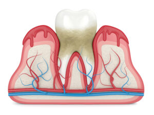 3d render of tooth in bleeding gums over white background. Periodontal disease concept.