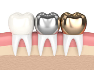 3d render of teeth with gold, amalgam and composite dental crown in gums