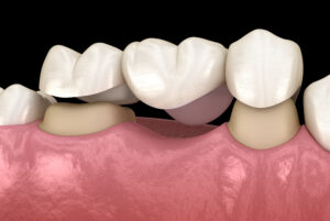 Dental bridge of 3 teeth over molar and premolar. Medically accurate 3D illustration of human teeth treatment