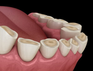 leawood bruxism