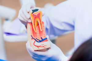 leawood root canal therapy