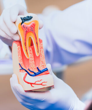leawood root canal therapy