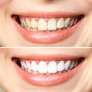 leawood teeth whitening