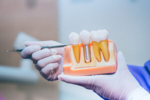 leawood dental implants