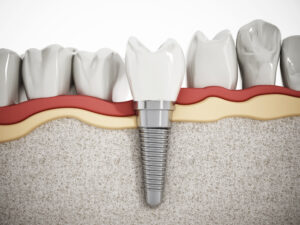 leawood dental implants