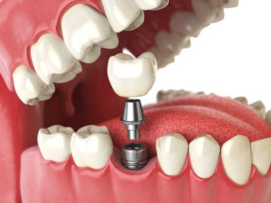 leawood dental implants