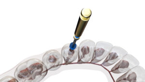 leawood root canal