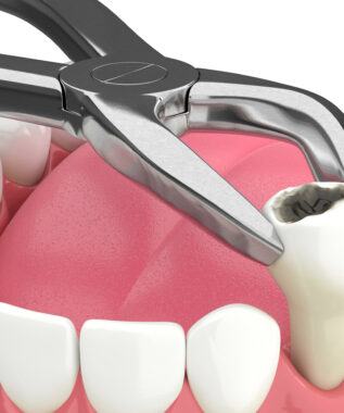 leawood tooth extraction