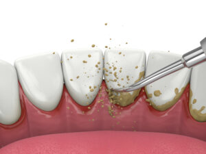 leawood scaling and root planing