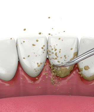 leawood scaling and root planing