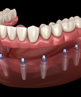 leawood implant dentures