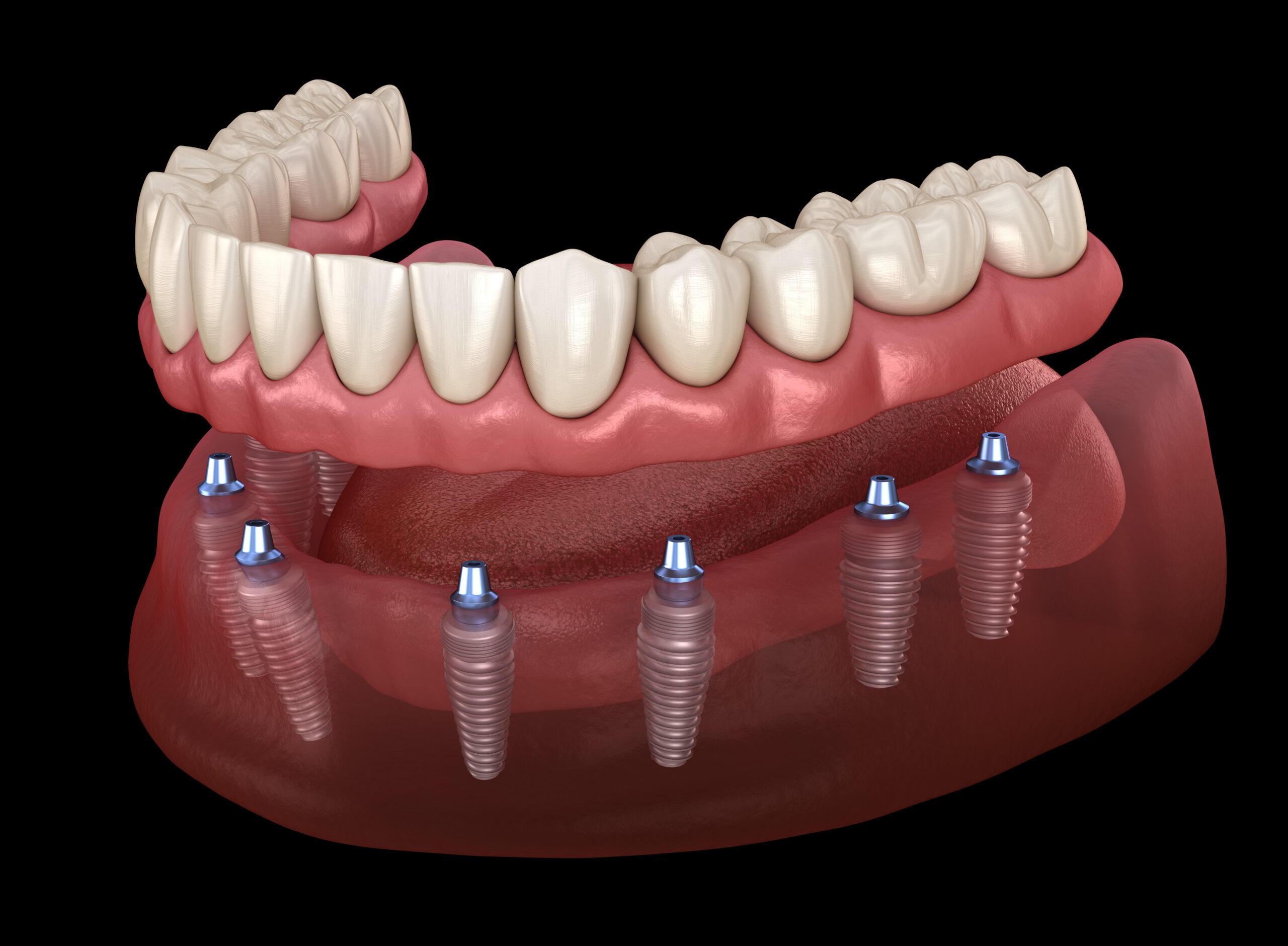 leawood implant dentures