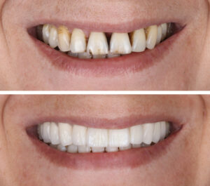 leawood veneers