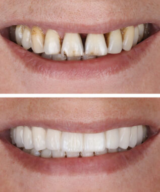 leawood veneers