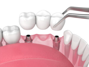 leawood dental bridge