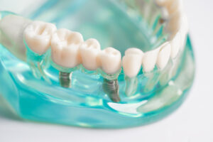 leawood dental implants