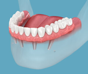leawood implant dentures