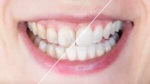 leawood teeth whitening