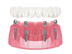 leawood all-on-four dental implants