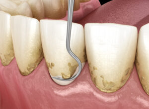 leawood scaling and root planing