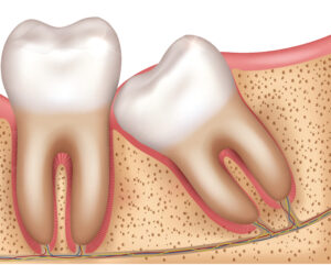 leawood dental extraction