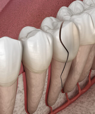 leawood cracked tooth