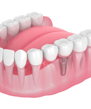leawood dental implants