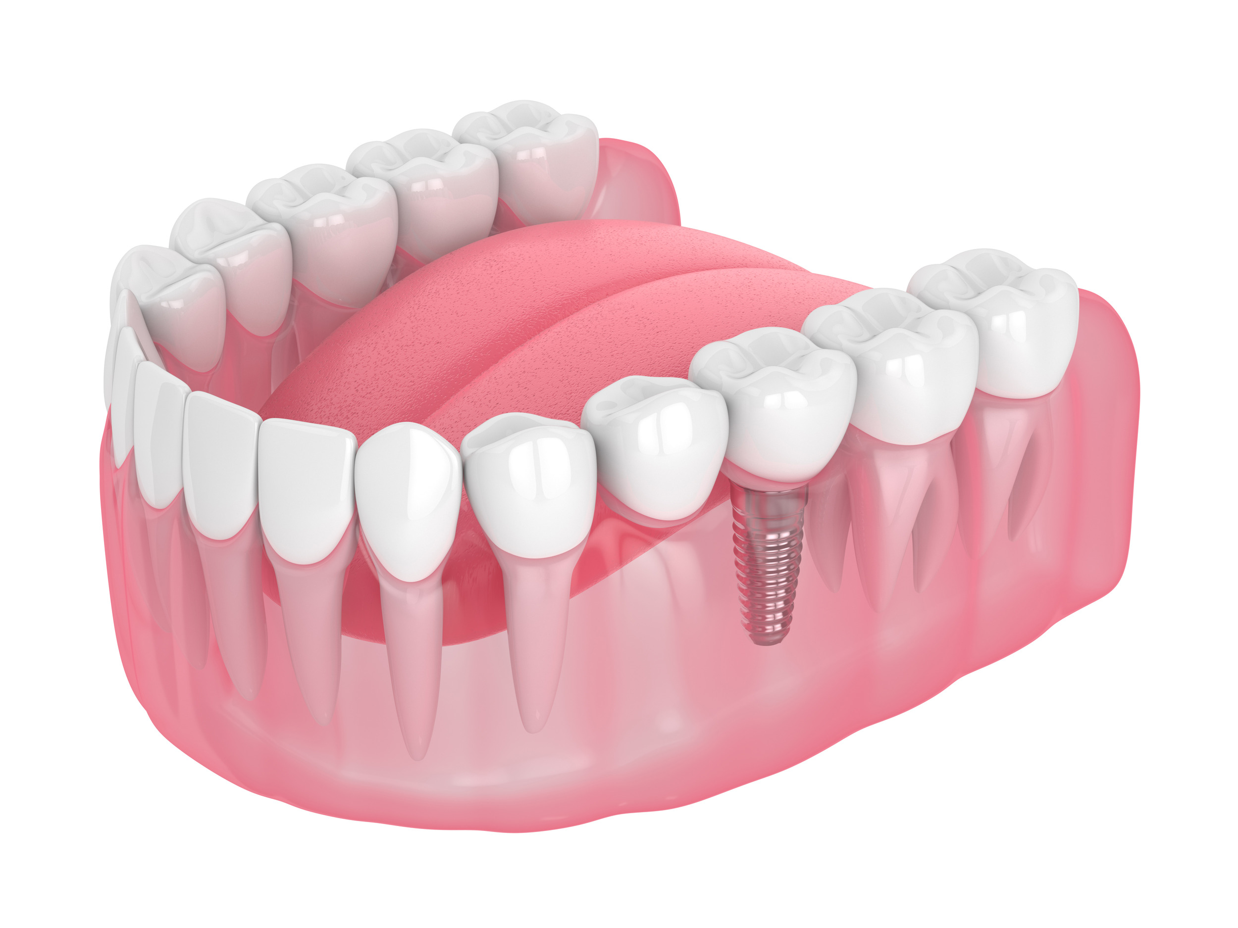 leawood dental implants