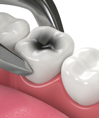 leawood tooth extraction