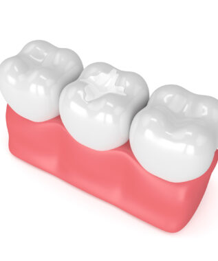 leawood dental filling