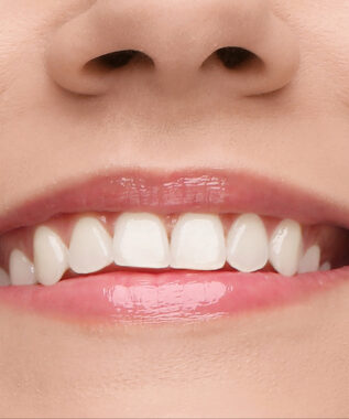 leawood veneers