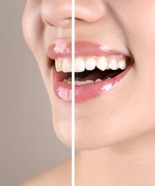 leawood teeth whitening