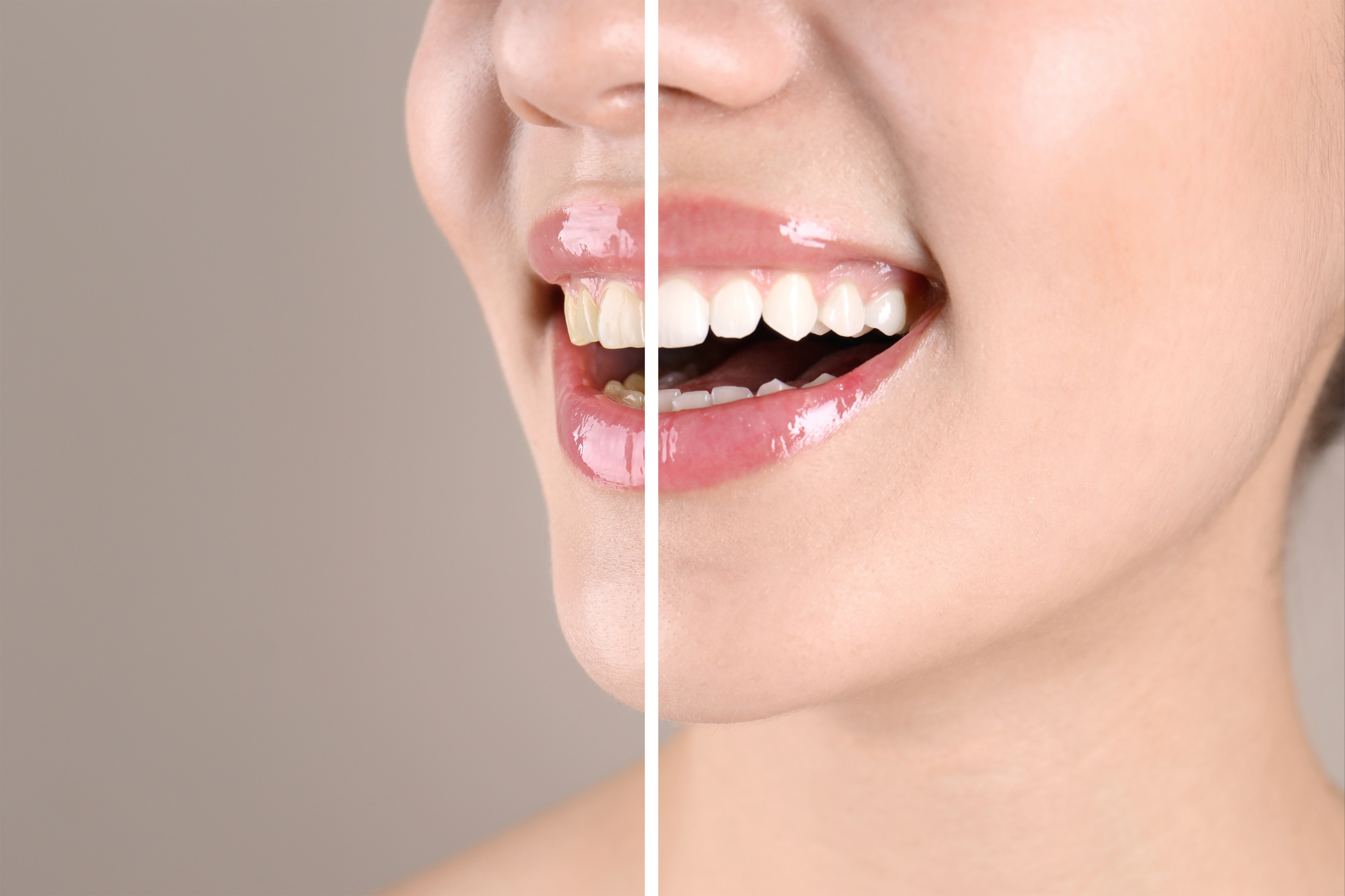 leawood teeth whitening